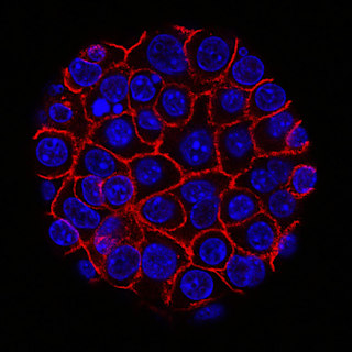 Pancreatic Cancer Vaccine Progresses