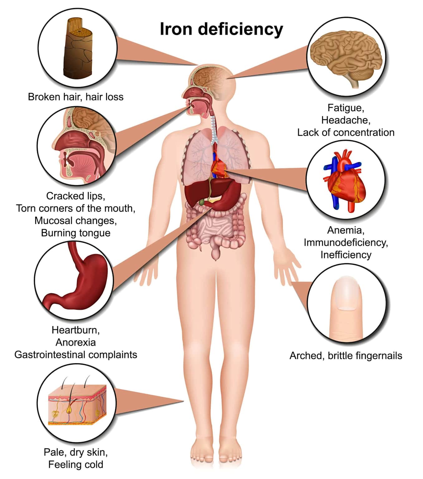 Medical infographic showing iron deficiency symptoms on a human body diagram including fatigue, brain fog, pale skin, brittle nails, shortness of breath, rapid heartbeat, and restless legs