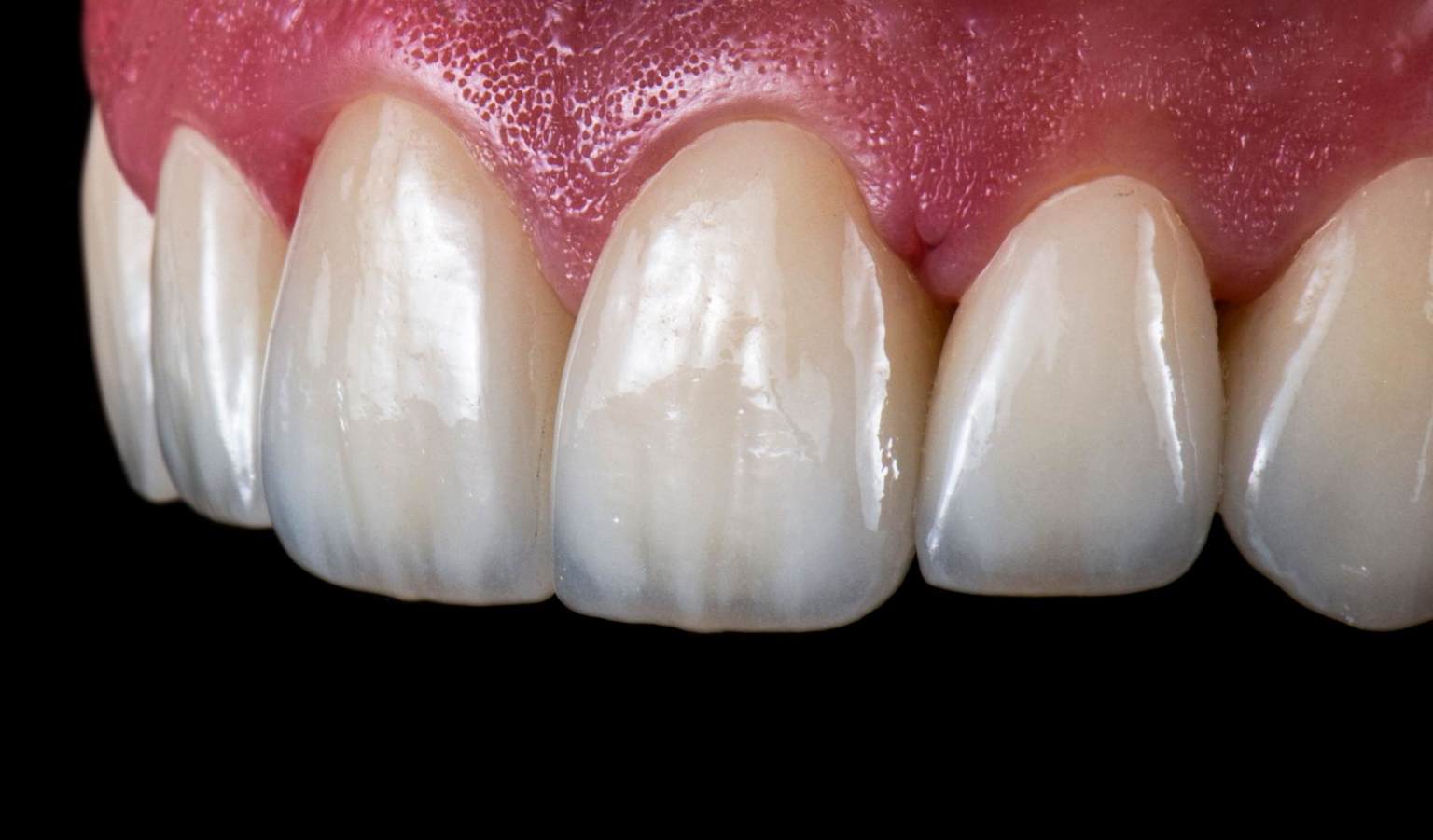 E-Max veneers aesthetic restorations