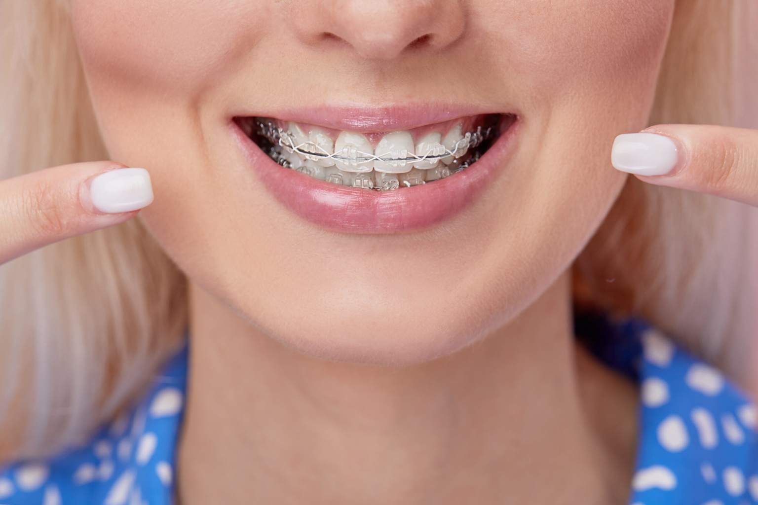 Close-up of a smiling person with clear ceramic orthodontic braces on teeth