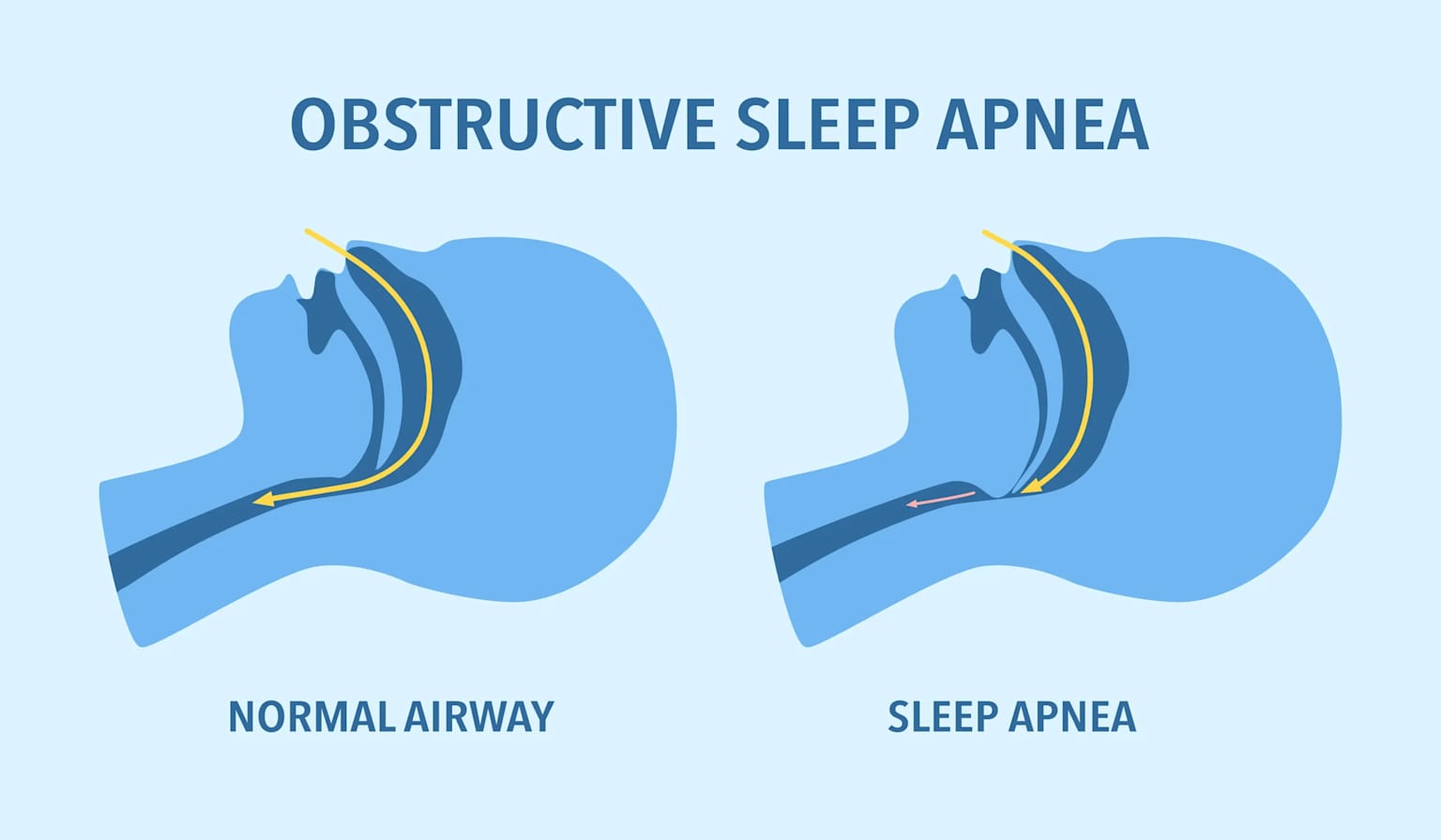 Sleep Apnea Without CPAP — 9 Treatments That Actually Work 1 Medical illustration comparing normal airway anatomy versus obstructed airway in obstructive sleep apnea, showing side profiles of head and throat