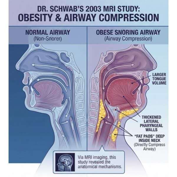 MRI comparison of normal airway vs obese airway showing fat deposits compressing breathing passage