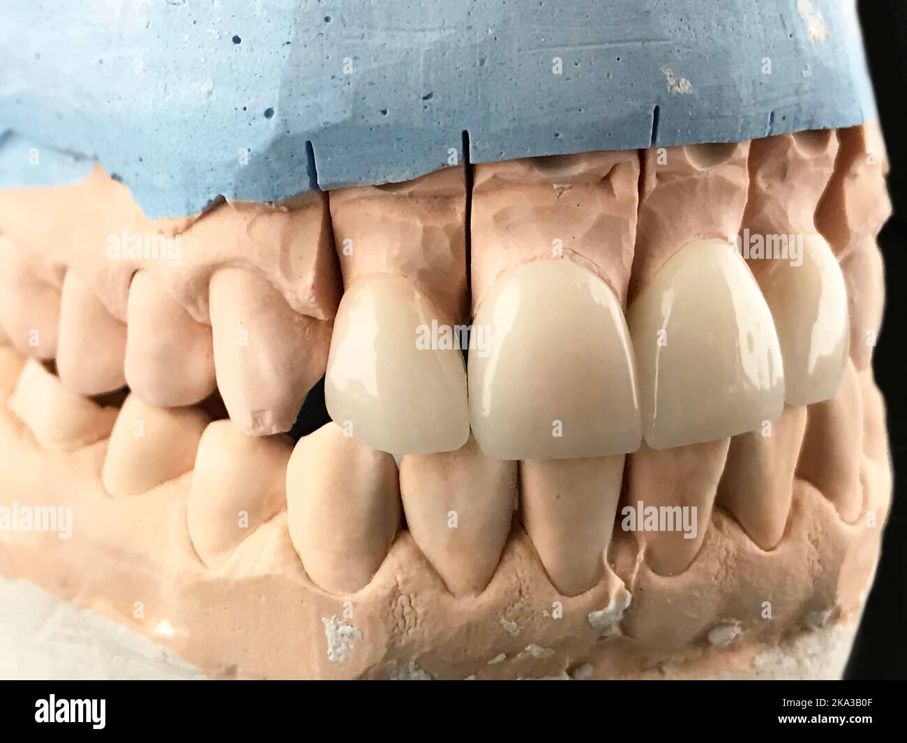 Zirconia crowns and bridges