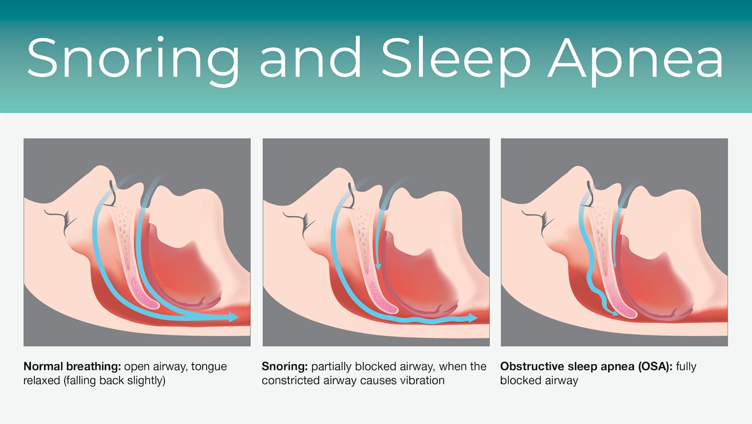 Medical illustration comparing normal breathing, snoring with partial airway obstruction, and obstructive sleep apnea with full airway collapse
