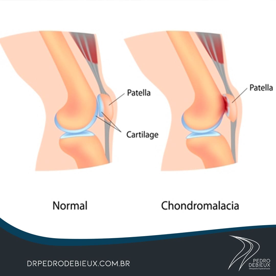 Anatomia do joelho normal versus joelho com condromalácia patelar, mostrando a cartilagem afetada