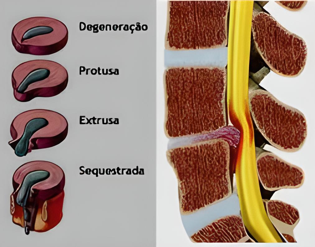 Ilustração médica mostrando estágios de degeneração e hérnia de disco lombar: disco degenerado, protruso, extruso e sequestrado
