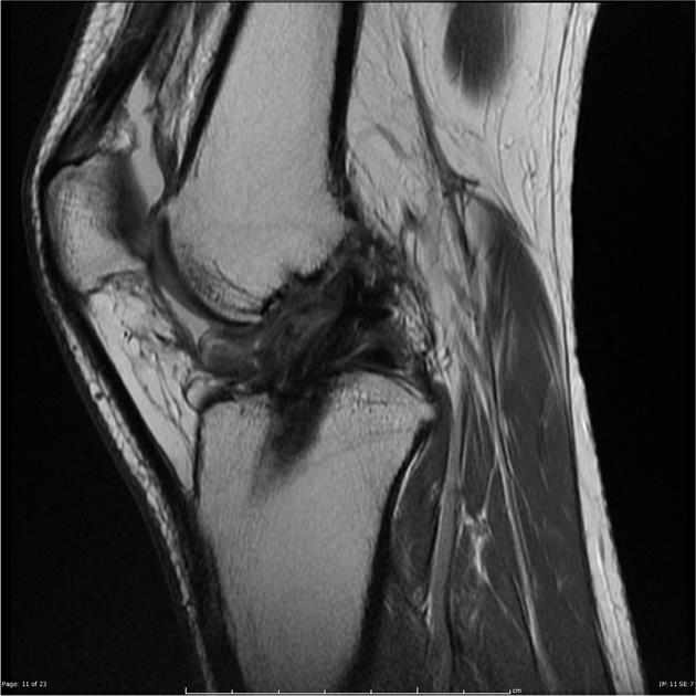 Arthrofibrosis | Radiology Reference Article | Radiopaedia.org