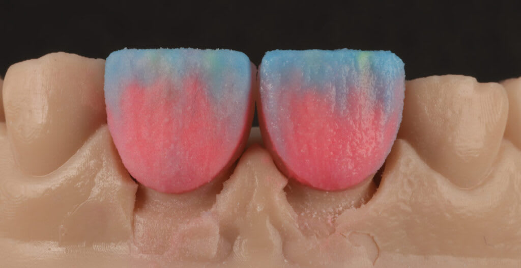 Precision dental crowns at Vita Dental Laboratory