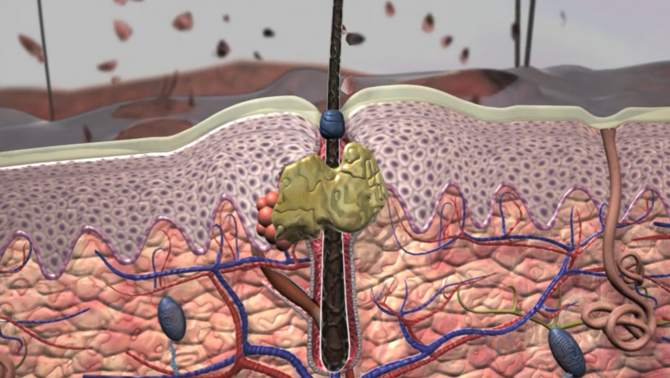 3D dermatology animation showing skin layers and treatment target