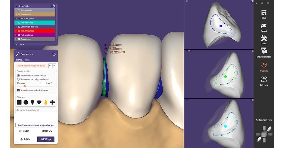 Modern exocad dental CAD interface