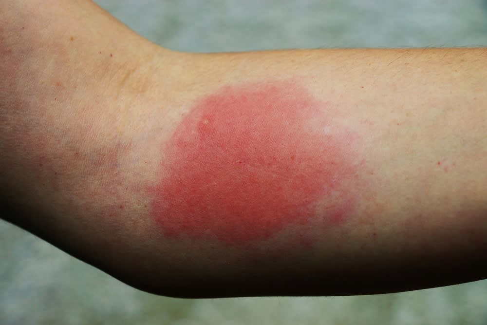 Wasp sting danger allergy reaction Toronto Nomore Pest