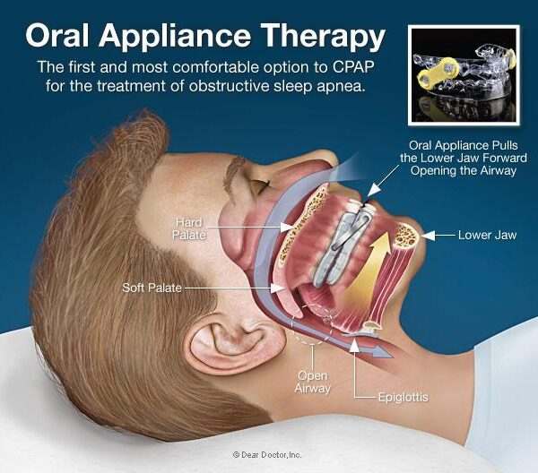 Sleep Apnea Without CPAP — 9 Treatments That Actually Work 5 Medical diagram showing how oral appliance works in the human mouth positioning jaw forward to open the airway for sleep apnea