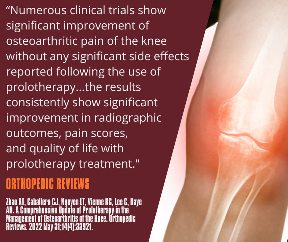 Retatrutide Phase 3 Results: Up to 71.2 lbs Lost and Significant Osteoarthritis Pain Relief 4 Knee osteoarthritis treatment illustration