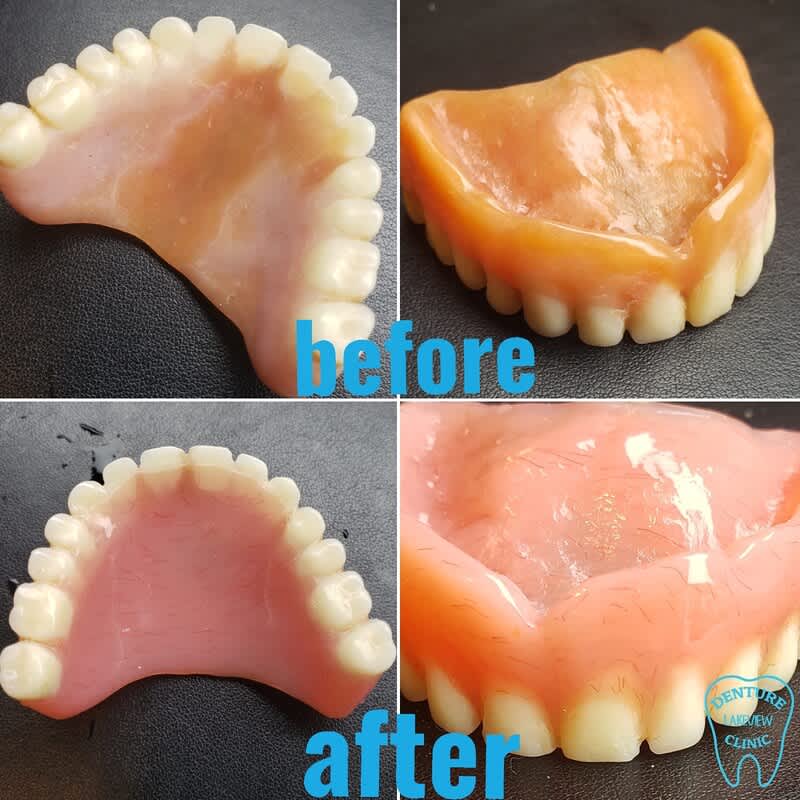 Denture reline before after