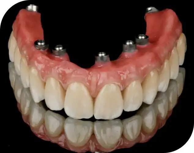 Implant supported dental prosthesis