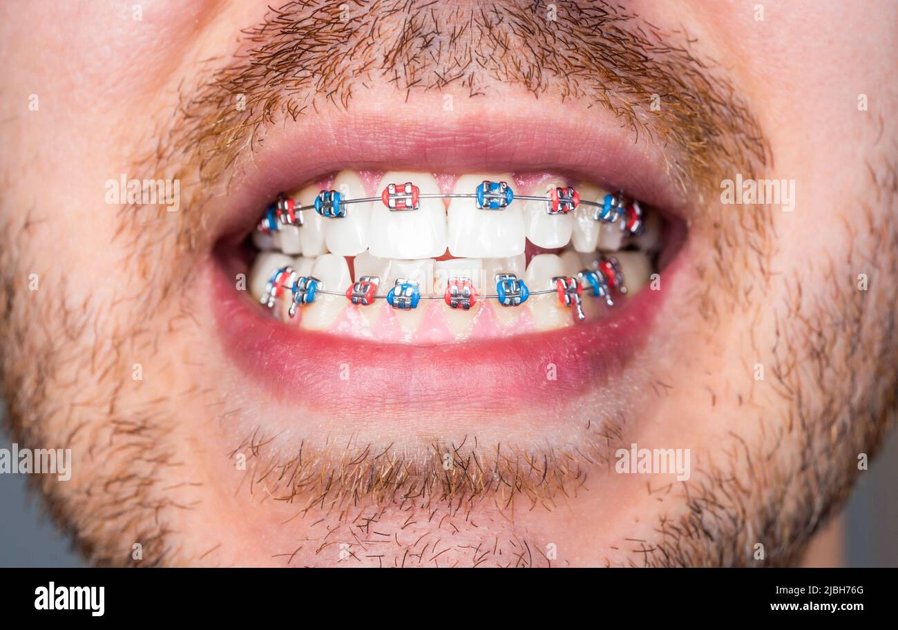 Macro close-up of traditional metal orthodontic braces on teeth showing stainless steel brackets and archwire