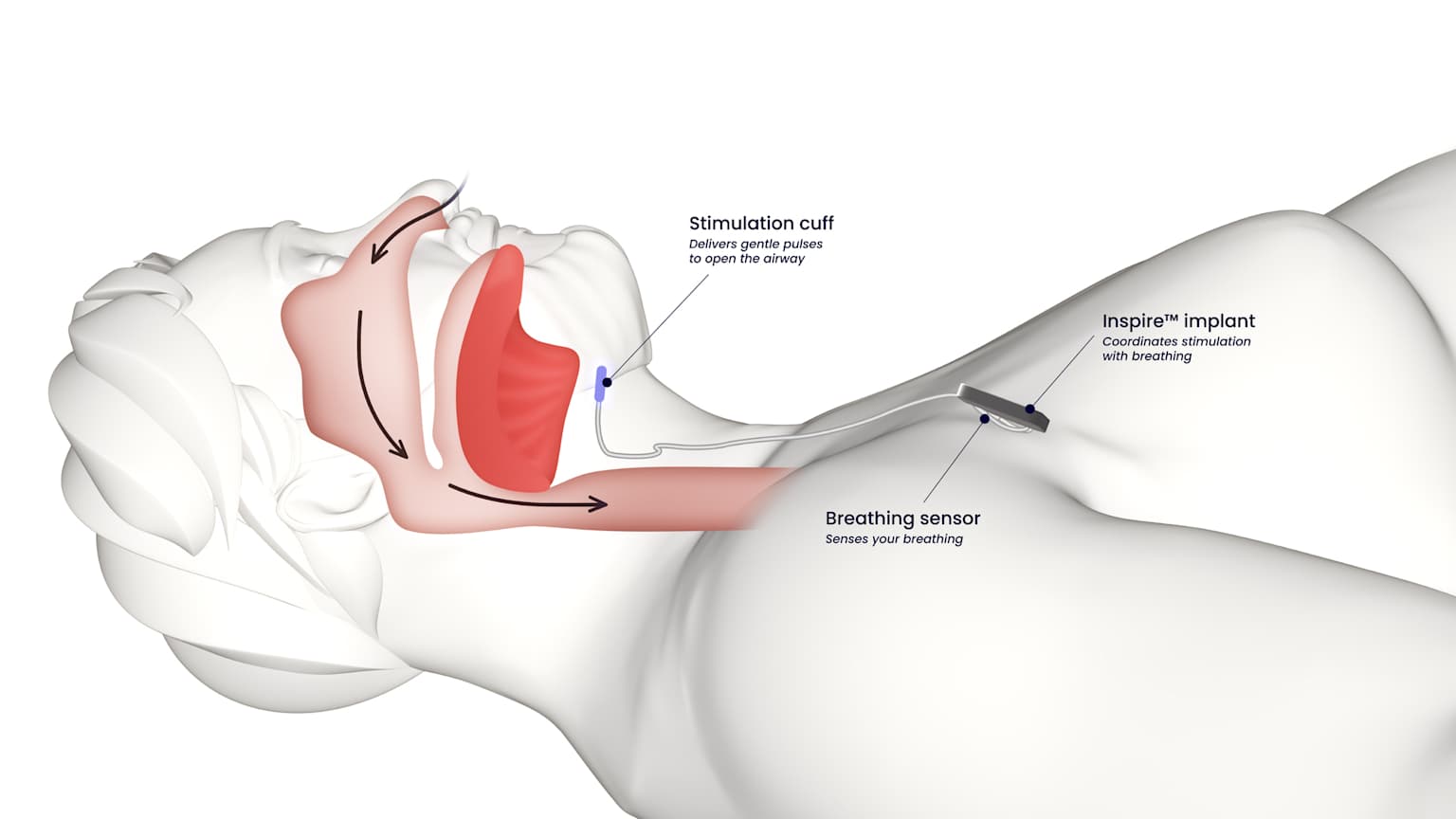 Sleep Apnea Without CPAP — 9 Treatments That Actually Work 8 Medical illustration of Inspire hypoglossal nerve stimulation implant in head and neck showing stimulation cuff on hypoglossal nerve and breathing sensor