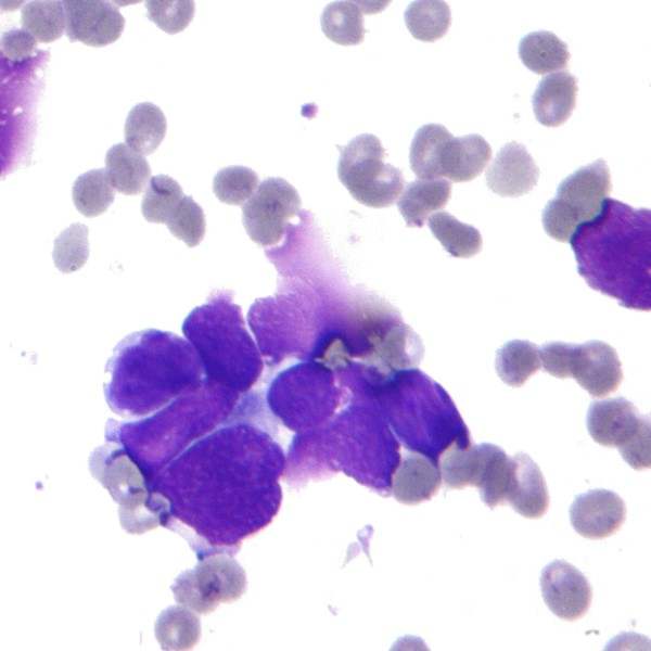 cytology image of breast cancer cells