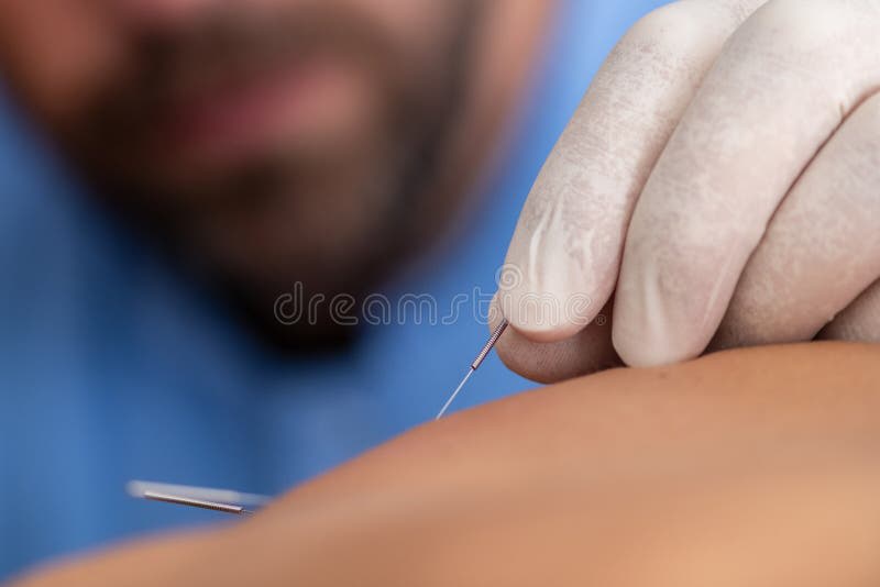 Fisioterapeuta realizando dry needling nas costas do paciente