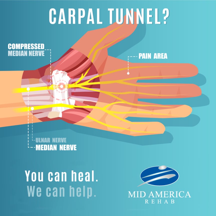 Ilustração do nervo mediano comprimido no túnel do carpo com destaque para a área de sensibilidade afetada
