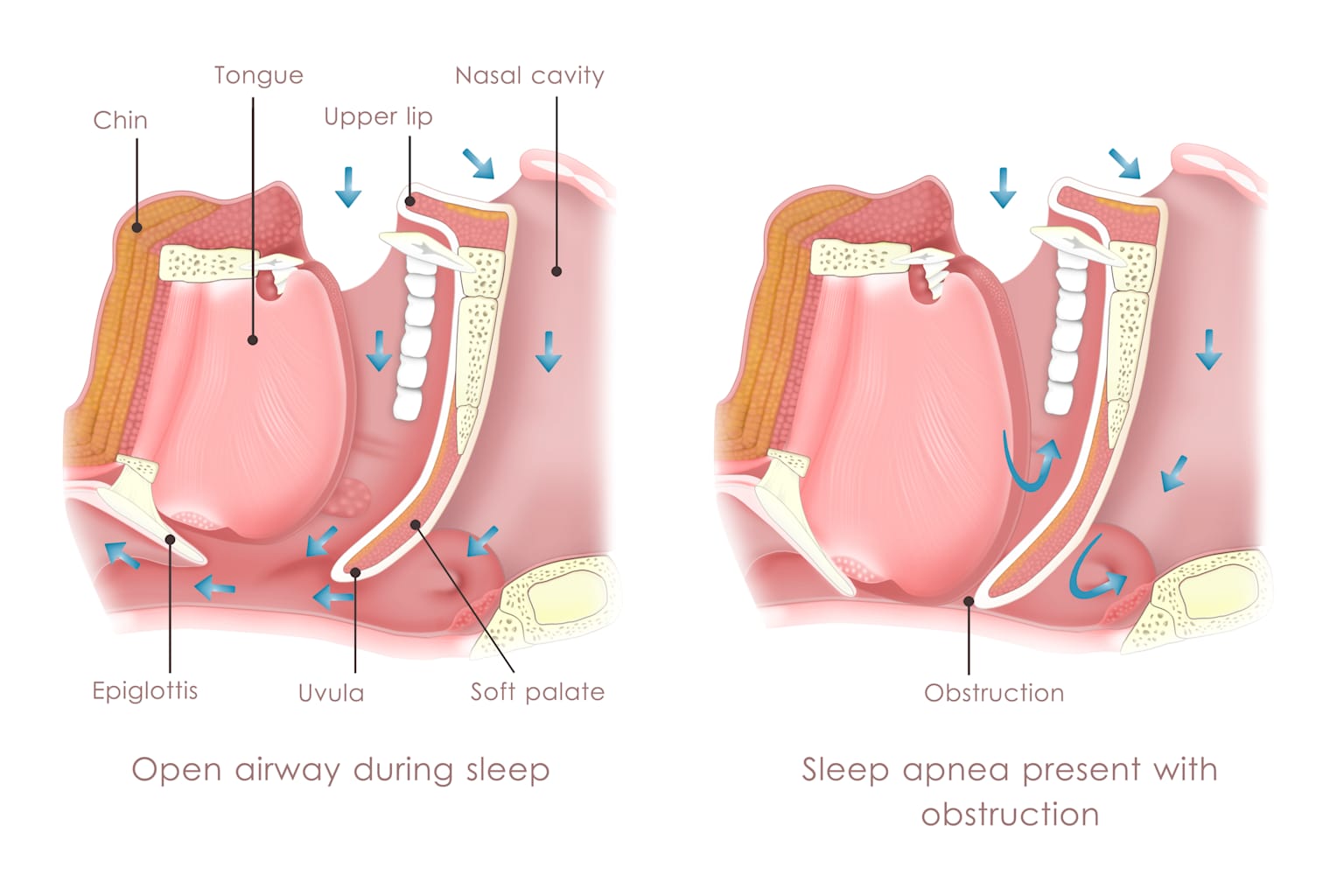 Sleep Apnea Without CPAP — 9 Treatments That Actually Work 2 Anatomical diagram of open airway versus obstructed airway in sleep apnea showing soft palate, uvula, tongue, epiglottis and nasal cavity