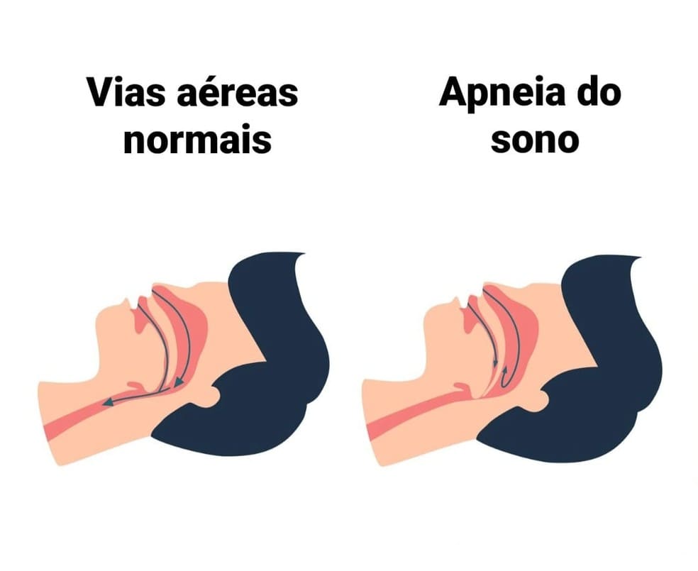 Comparação entre via aérea normal e via aérea com apneia obstrutiva do sono