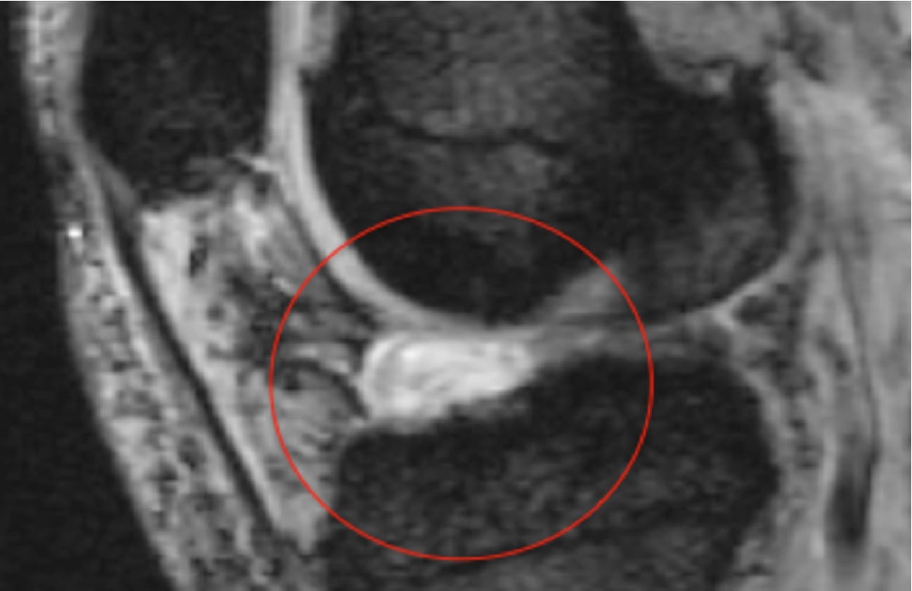 Figure 4 from Localized anterior arthrofibrosis (Cyclops ...
