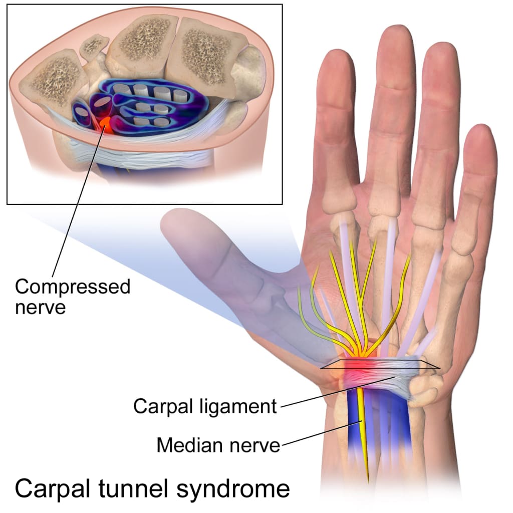 Ilustração anatômica do túnel do carpo mostrando o nervo mediano comprimido pelo ligamento transverso