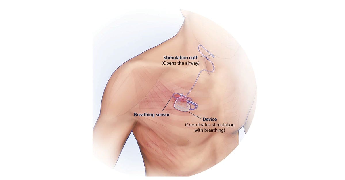 Sleep Apnea Without CPAP — 9 Treatments That Actually Work 9 Medical illustration of upper chest and shoulder showing implanted Inspire therapy device with stimulation and breathing sensor components labelled