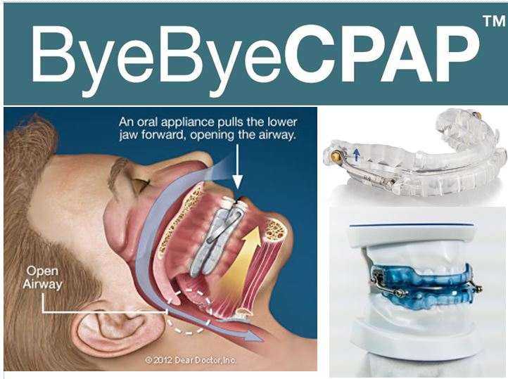 Sleep Apnea Without CPAP — 9 Treatments That Actually Work 6 Infographic comparing oral appliance therapy with CPAP mask for obstructive sleep apnea showing jaw advancement mechanism