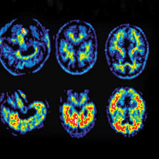 New Treatment May Delay Alzheimer's