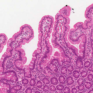 AI Diagnoses Celiac Disease