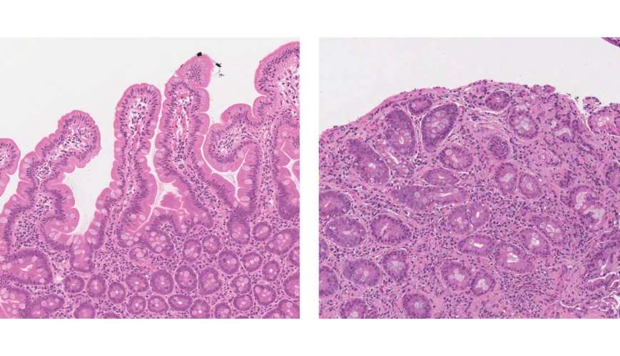 AI is as good as pathologists at diagnosing coeliac disease ...