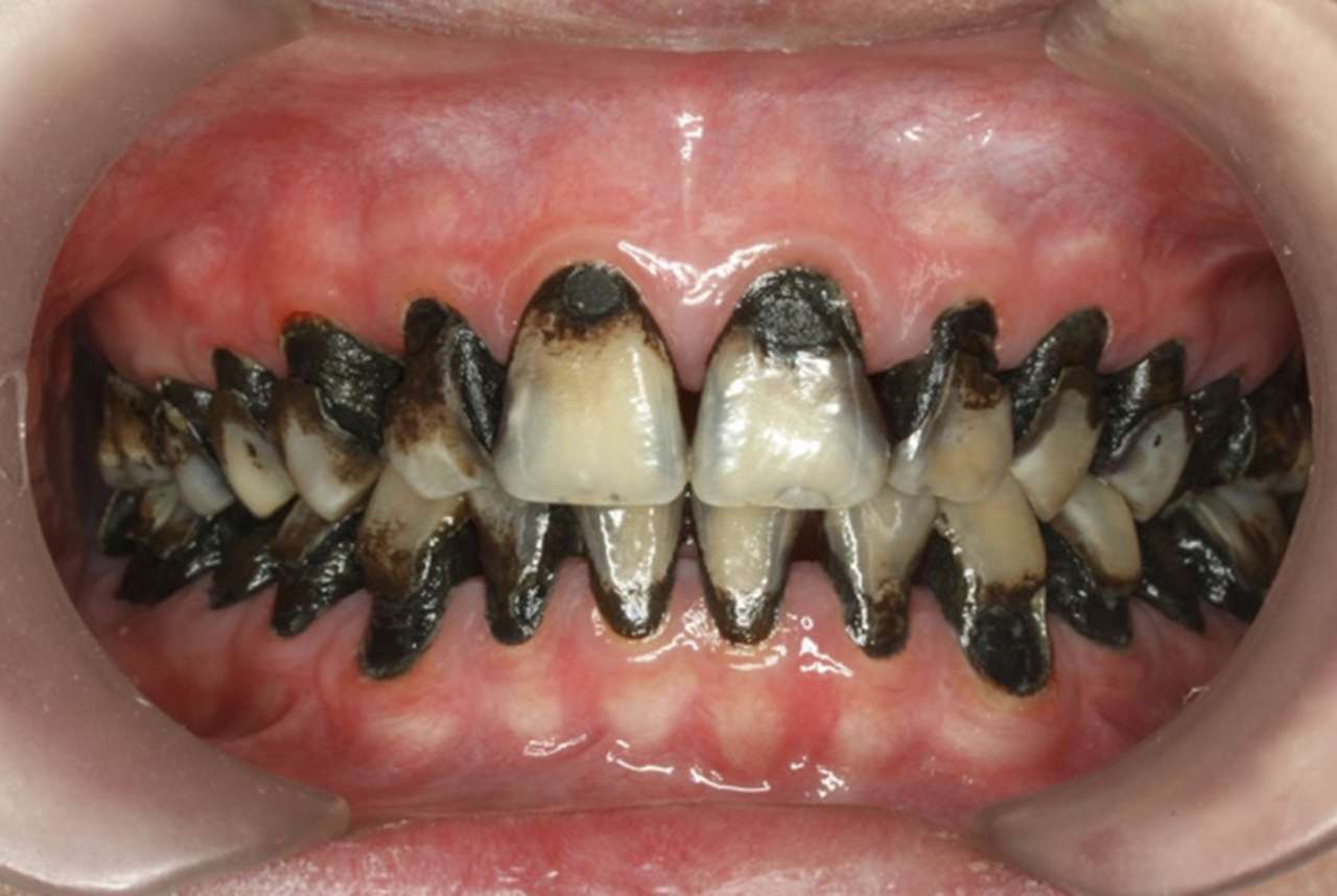 Teeth stained black following silver diamine fluoride treatment