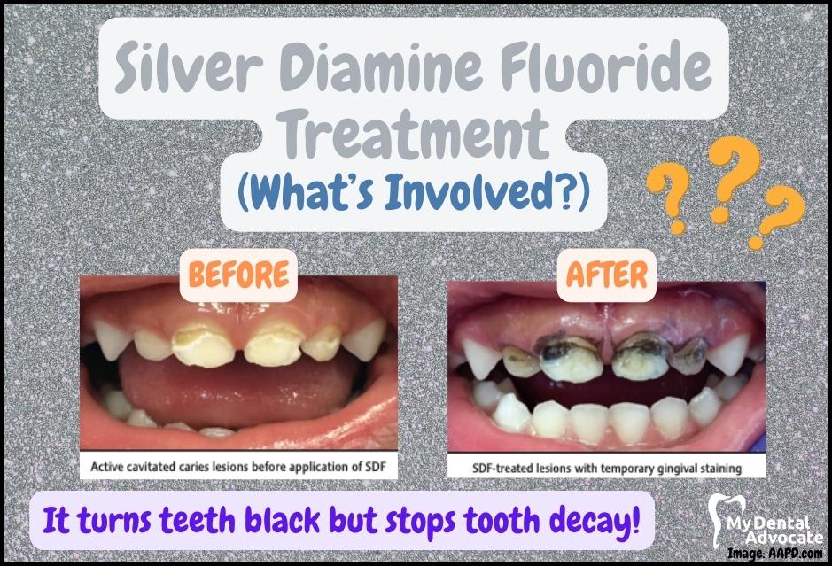 The effect of silver diamine fluoride treatment on teeth