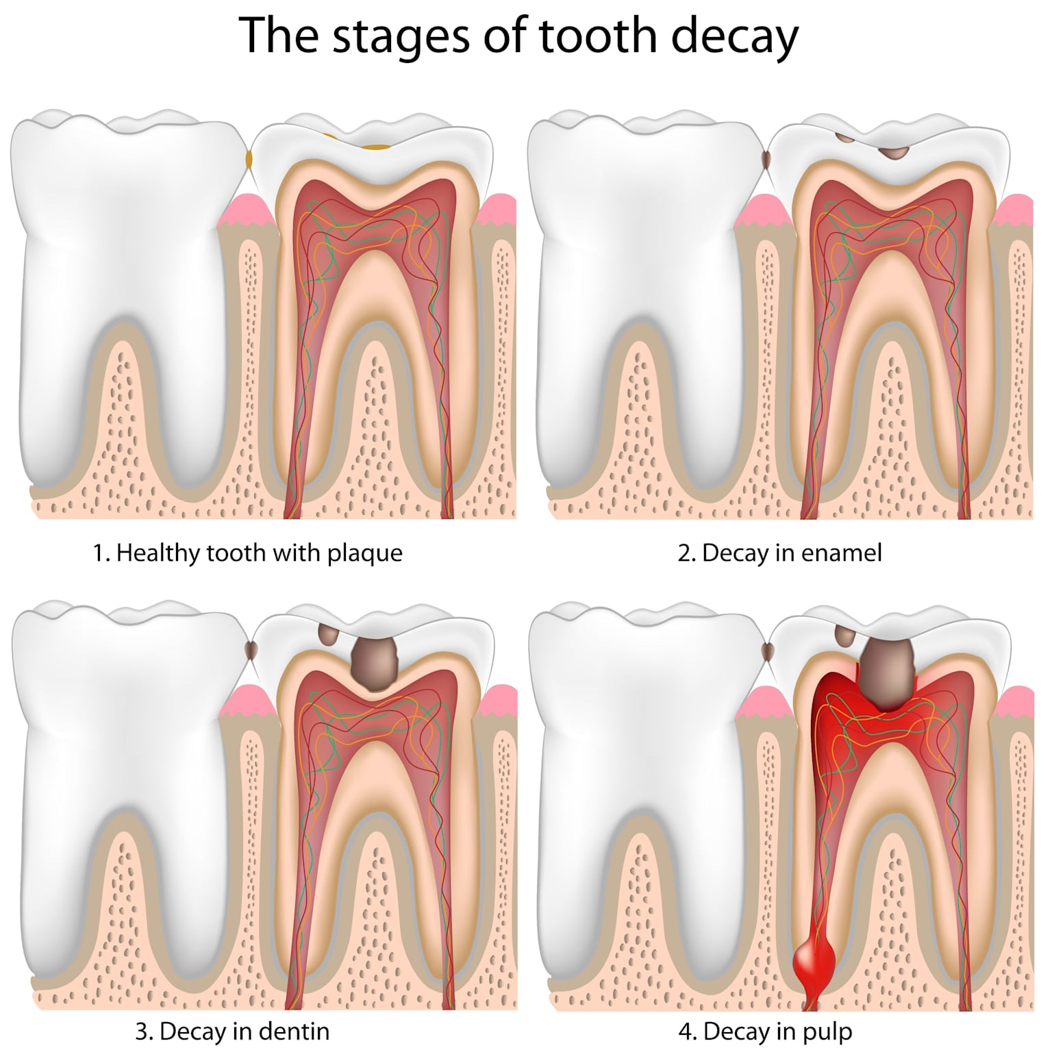 The Stages of Tooth Decay