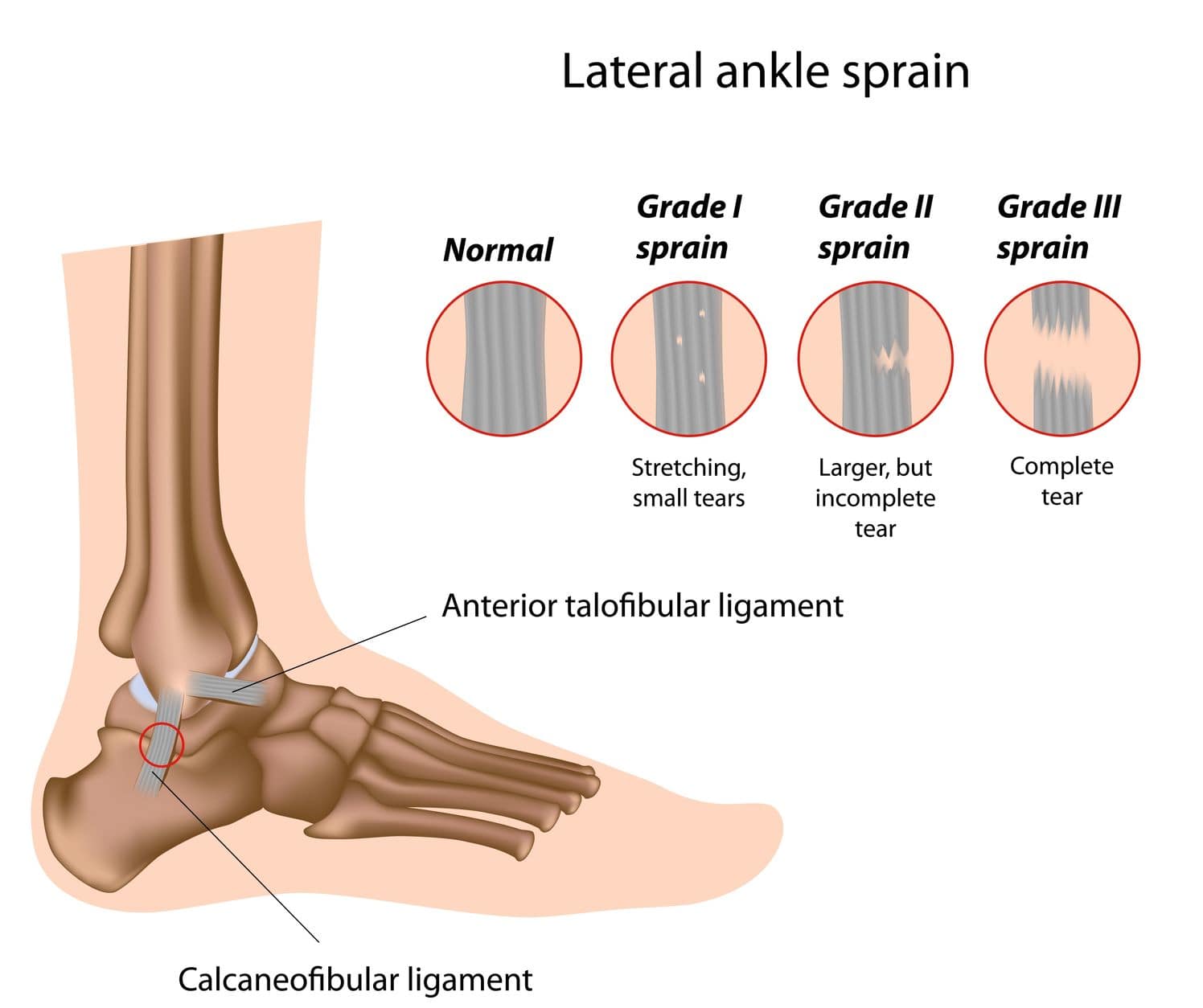 Illustration showing the anatomy of a lateral ankle sprain and the three grades of sprain severity, from mild stretching to complete ligament tear.