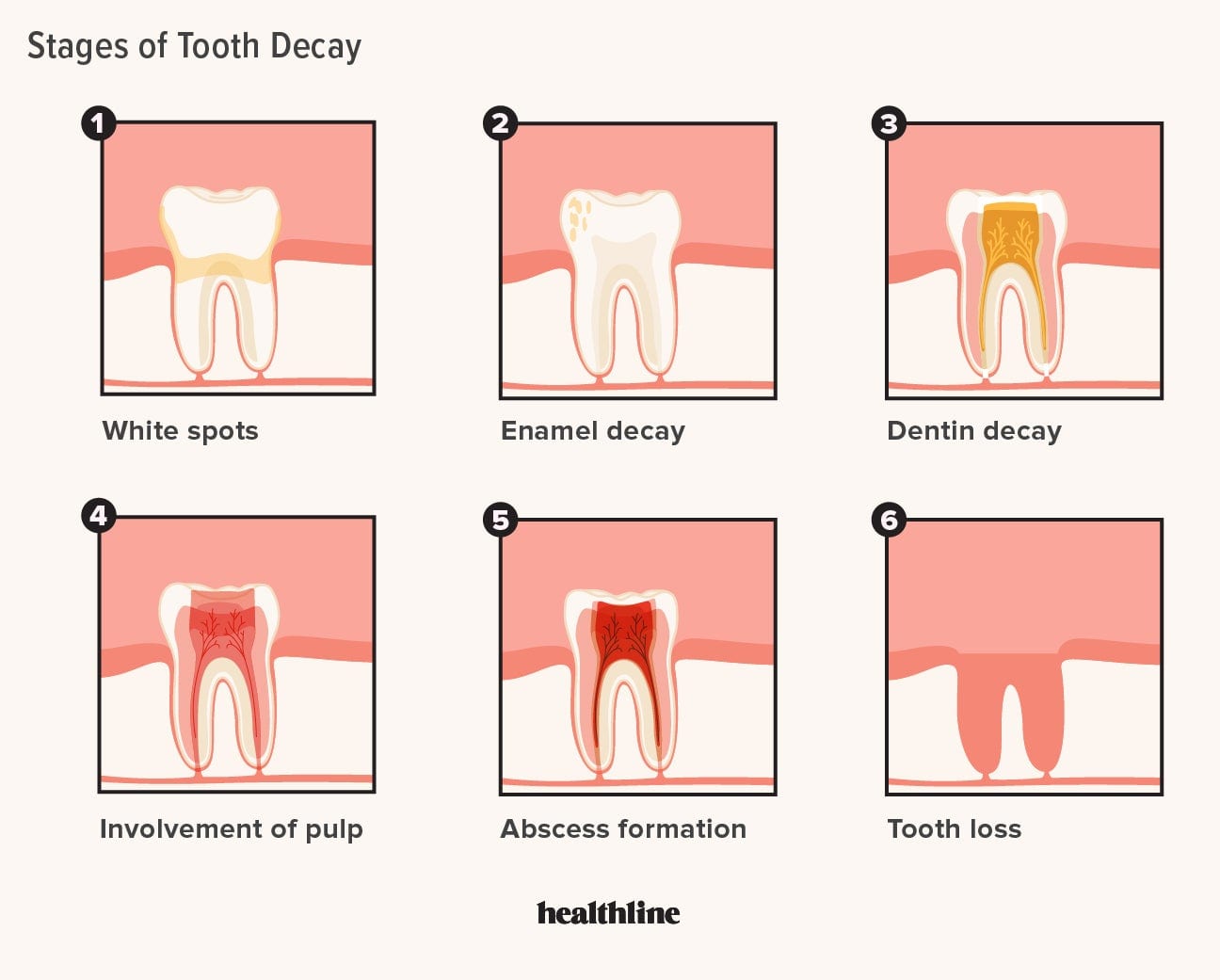 The Six Stages of Tooth Decay Progression