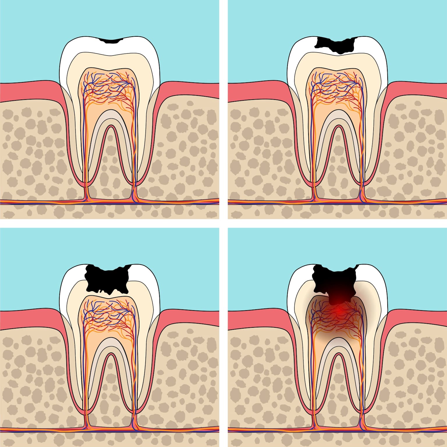 Illustration depicting the stages of tooth decay
