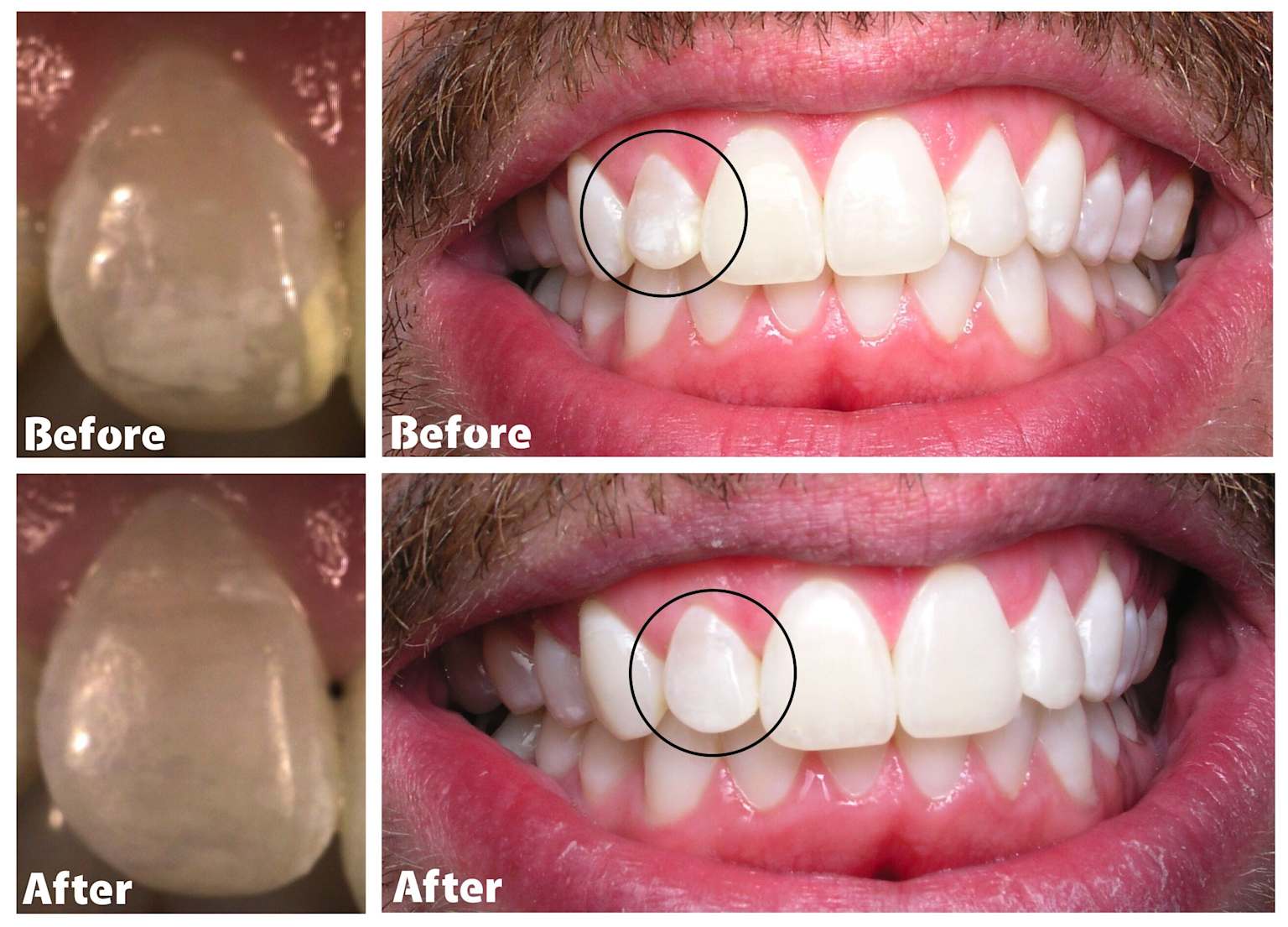 White spot lesion on a tooth before and after treatment