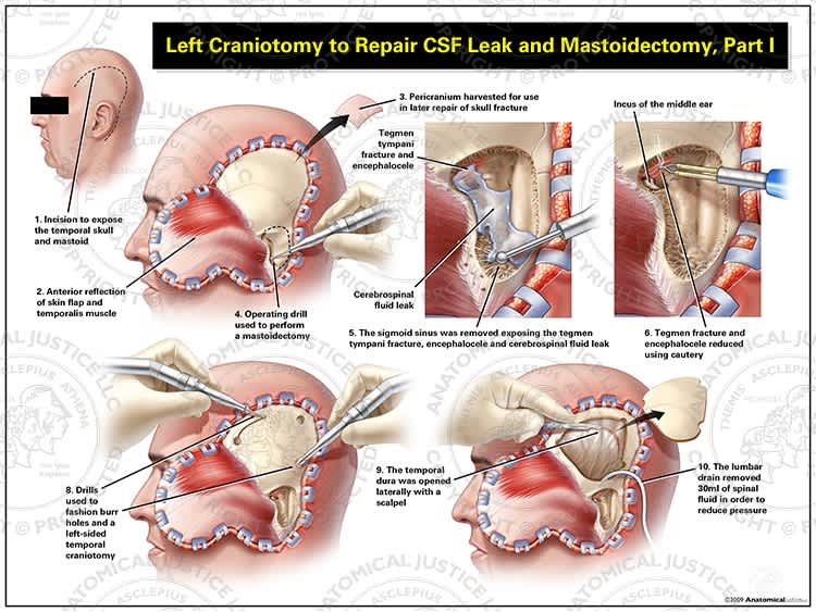 illustration of a left craniotomy procedure to repair CSF leak and mastoidectomy