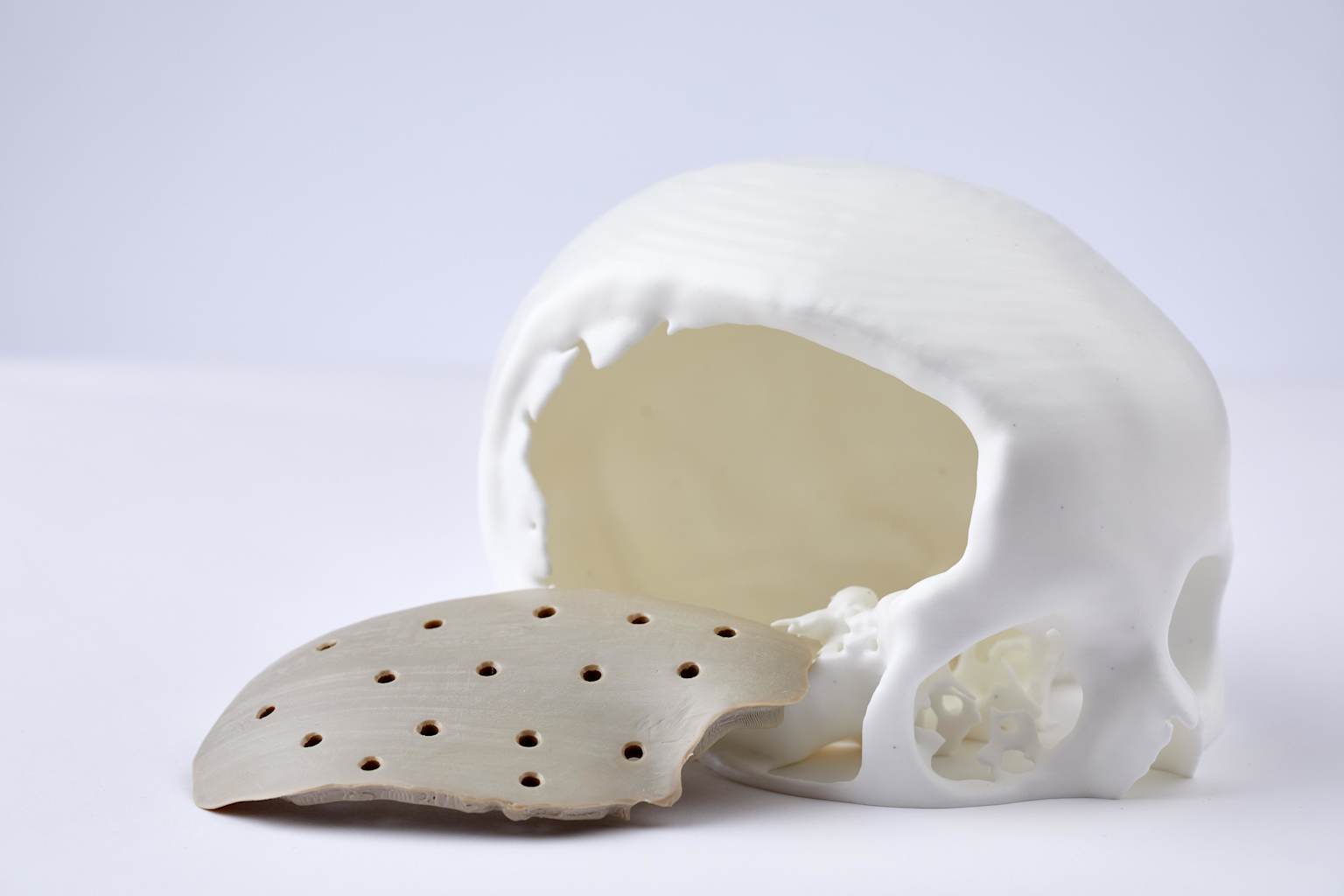 3D printed PEEK cranial implant alongside a skull model illustrating cranial reconstruction