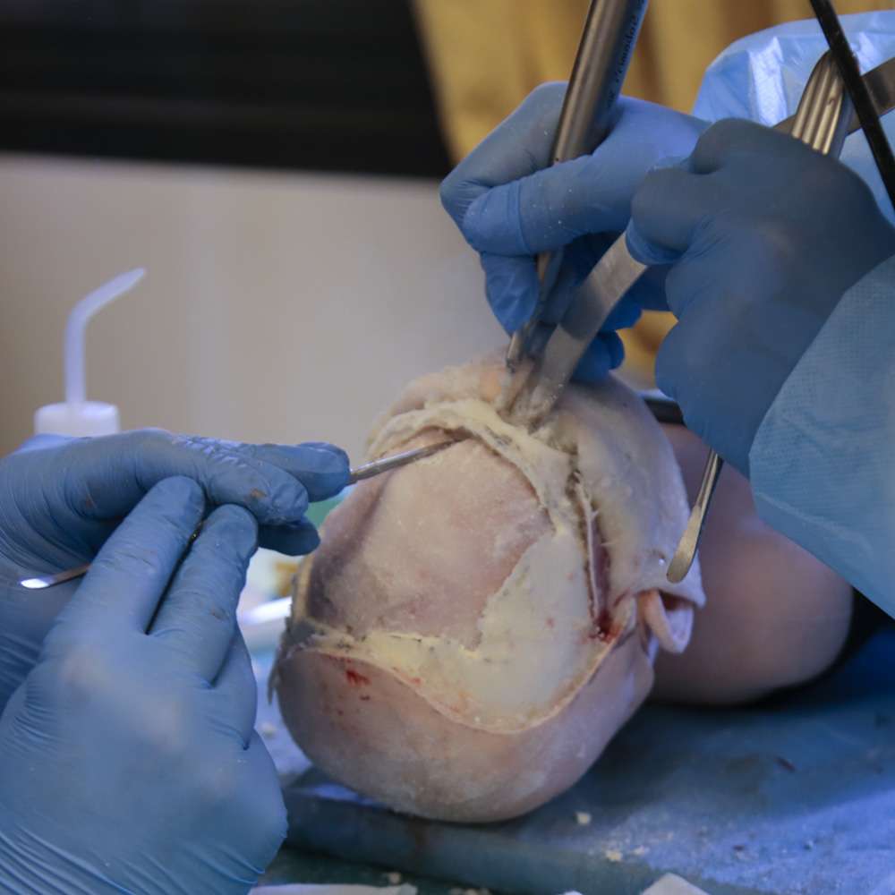 Surgical cranial reconstruction on a pediatric skull showing bone manipulation and repair