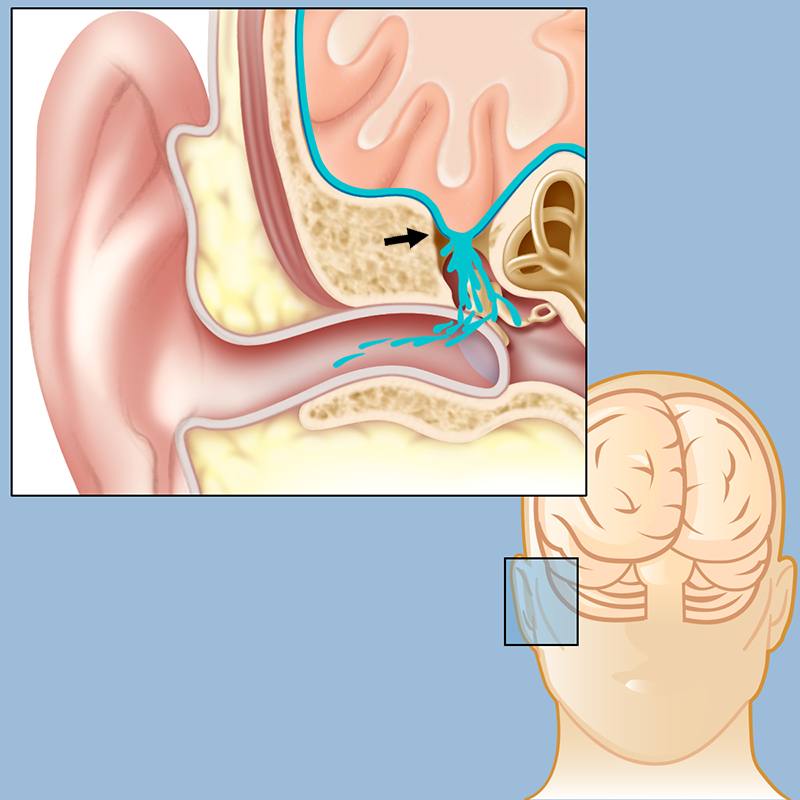 Medical illustration showing cerebrospinal fluid leaking through a dural tear near the ear canal