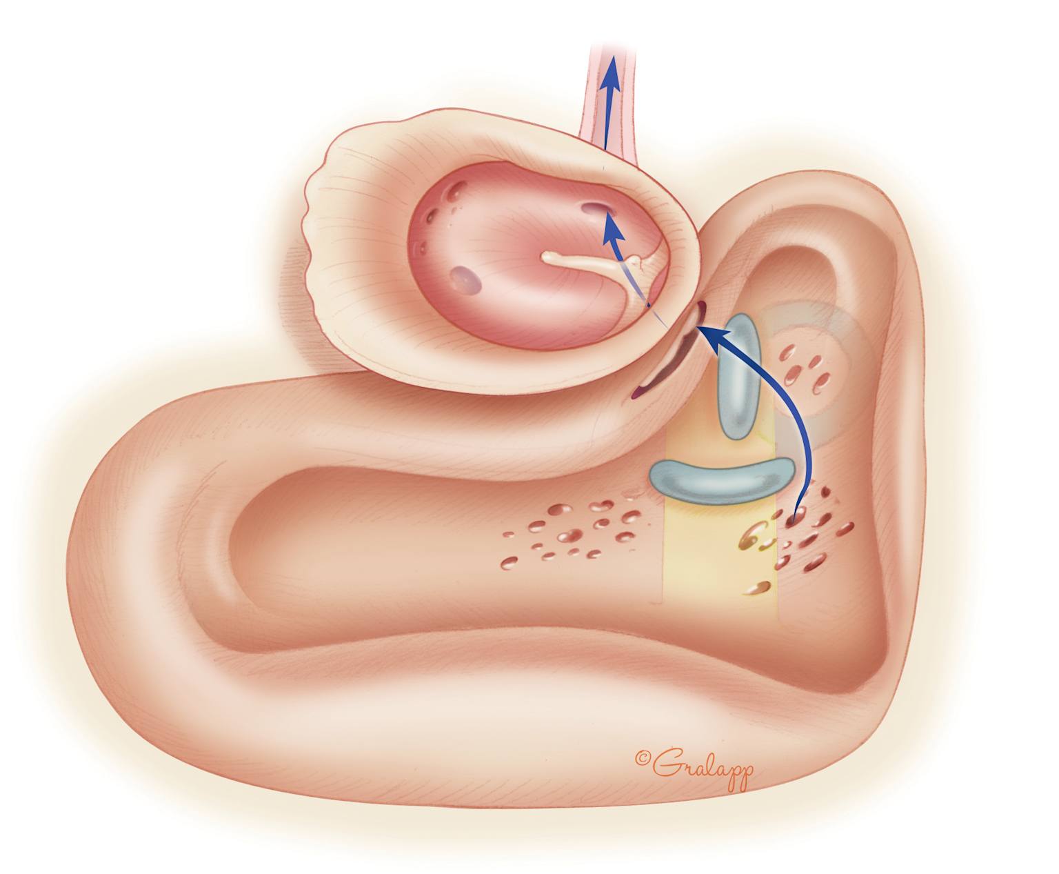 Medical illustration showing cerebrospinal fluid leakage pathway in the ear region after skull surgery