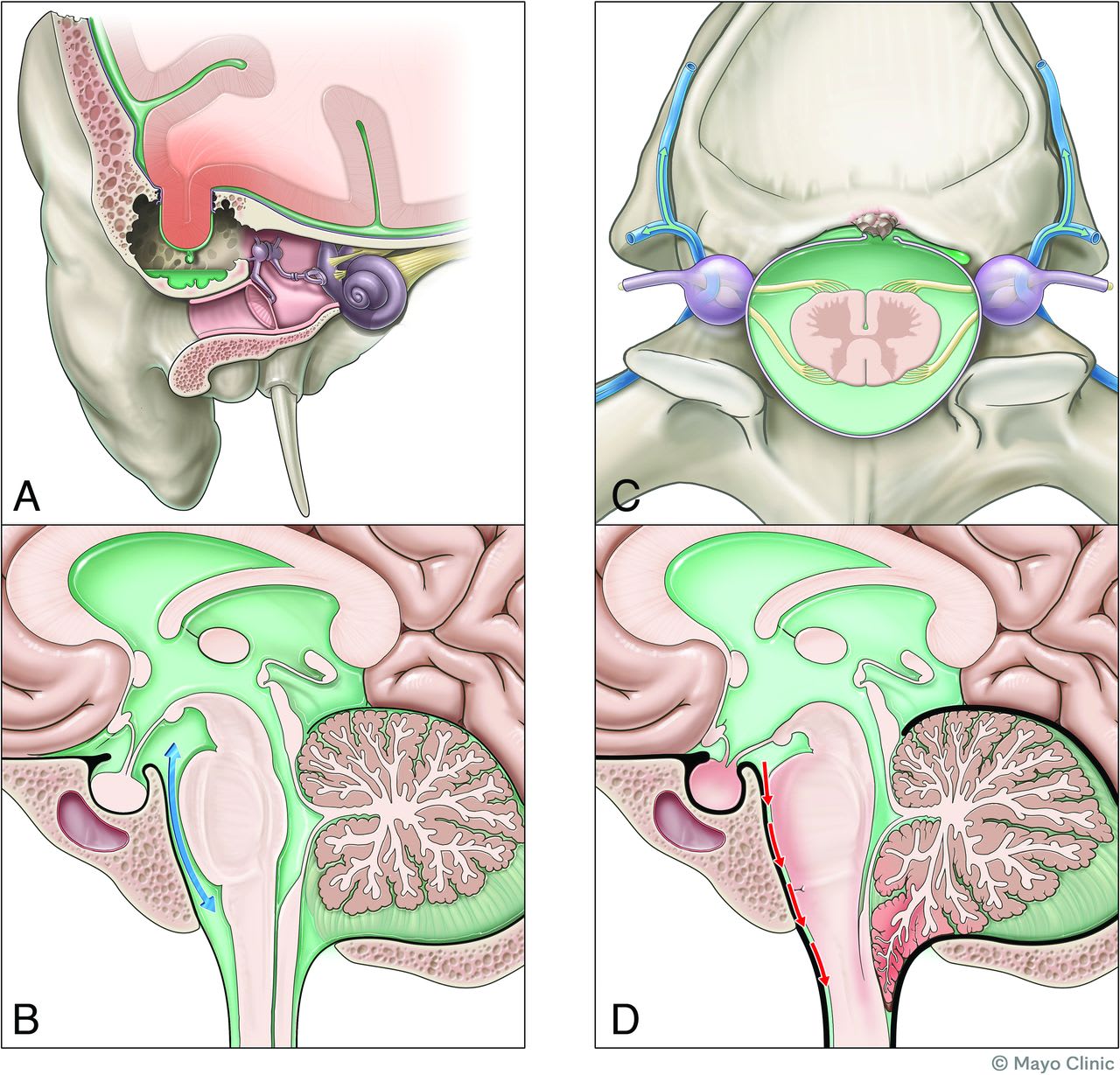 Medical illustration showing anatomy and pathways of cerebrospinal fluid leaks at the skull base and related structures