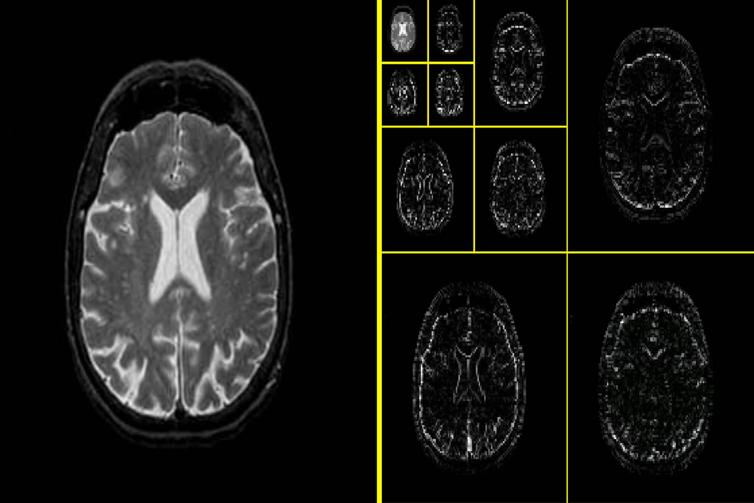 A medical brain scan showing an axial view and its wavelet decomposition for digital image compression
