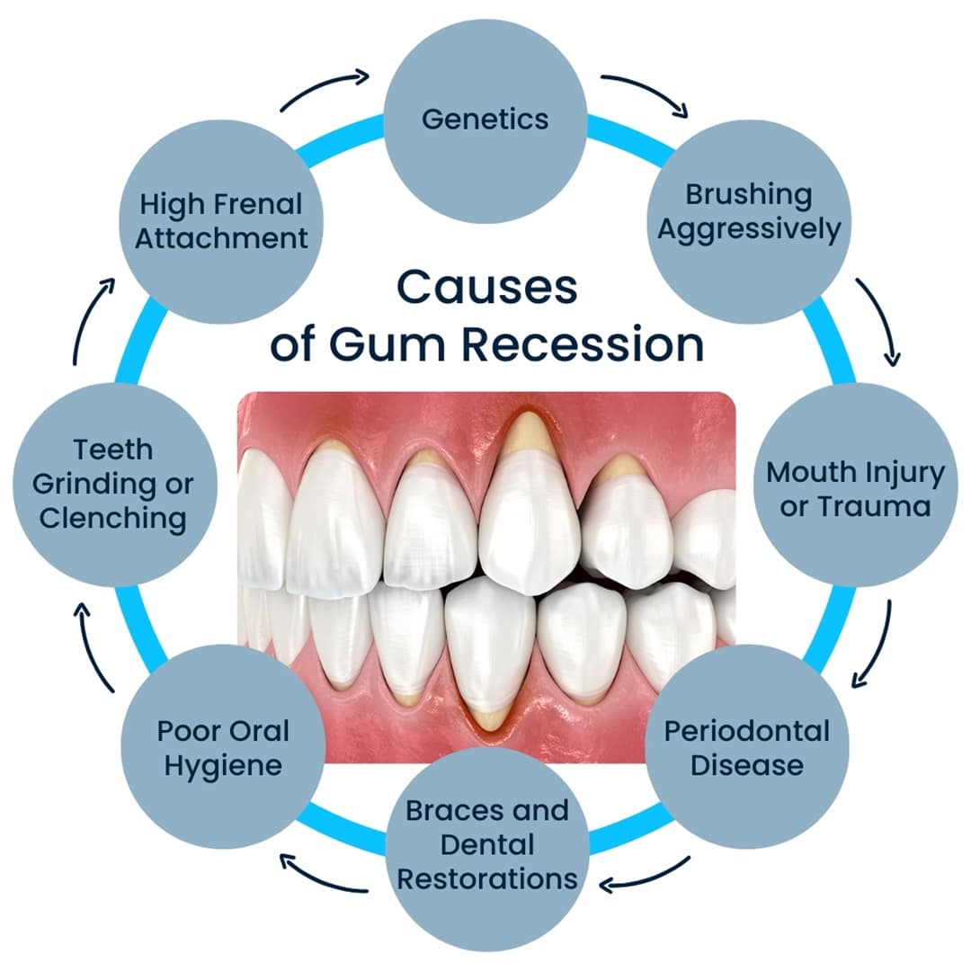 Infographic detailing the multiple causes of gum recession, including aggressive brushing, genetics, and poor oral hygiene