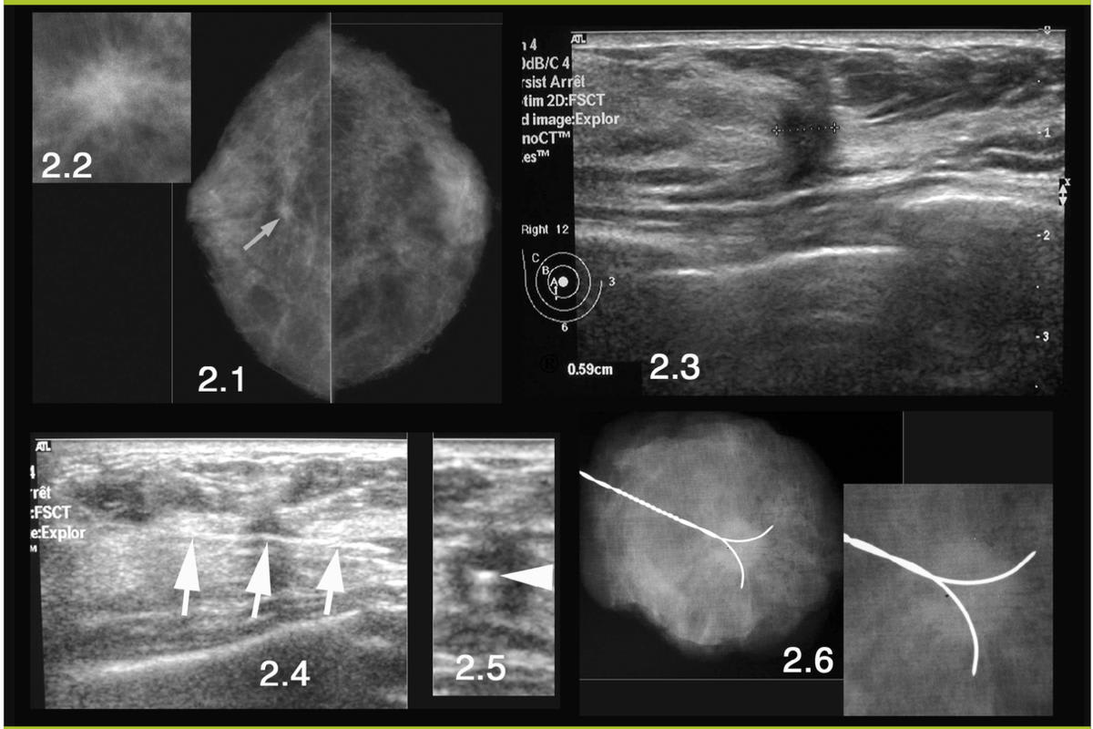 Medical imaging techniques, including mammography and ultrasound, used for guided breast biopsy and localization procedures