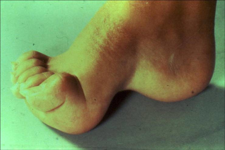 Foot deformity with high arch and claw toes commonly seen in Charcot-Marie-Tooth disease